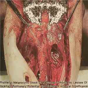 Carcinomas Of Unknown Primary Origin - Proliferal Melanocytic Shock Of Recurring Tumorigenic Lesions Of Uncertain Pulmonary Potential And Malignant Atypical Significance download free